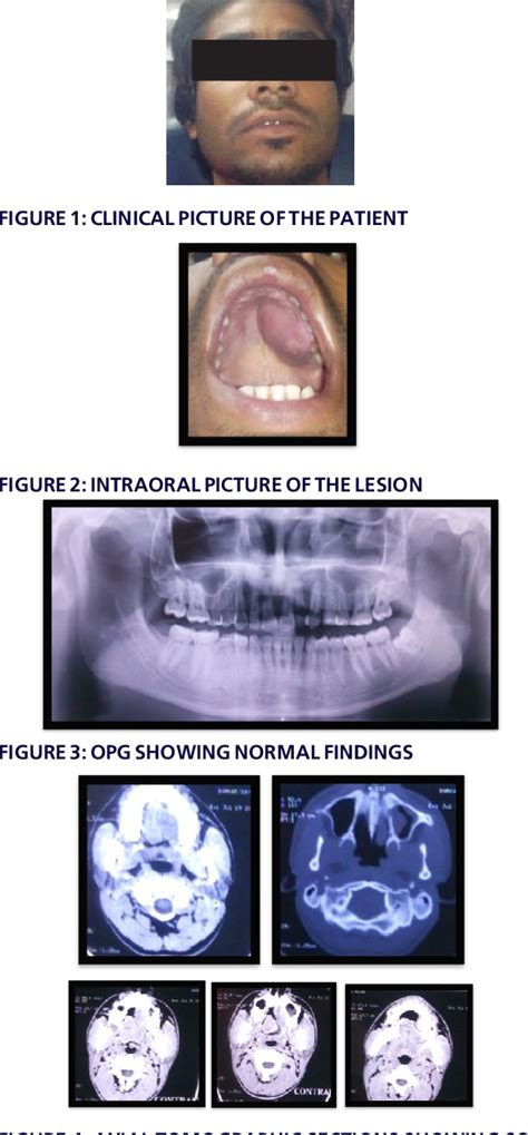 Figure 2 From Surgery Pleomorphic Adenoma Of The Hard Palate A Case