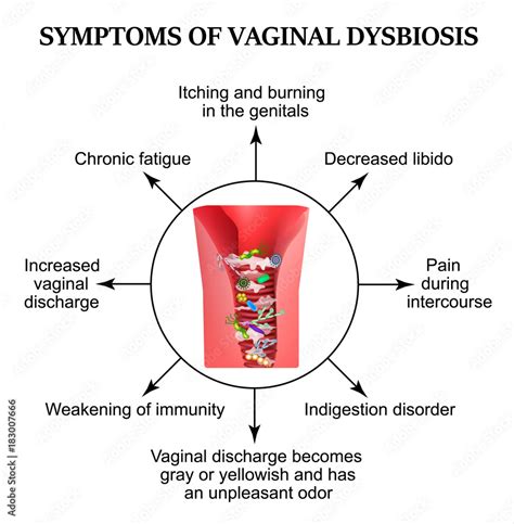 Vecteur Stock Symptoms Of Vaginal Dysbiosis Vaginitis Candidiasis