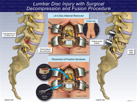 Lumbar Disc Injury With Surgical Decompression And Fusion Procedu