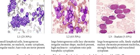 Figure 1 From Acute Lymphocytic Leukemia In Adults Pathologic Features