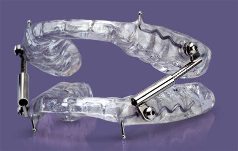 Glidewell Oasys Hinge Dental Sleep Apnea Clinic