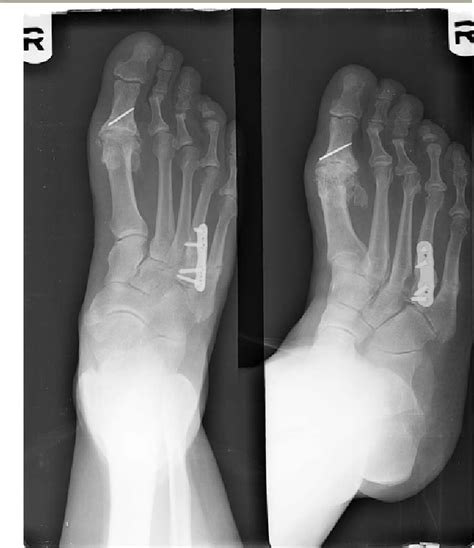 Pdf Treatment Of Fourth Metatarsal Base Fracture Non Unions In Middle