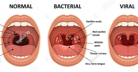 Tonsils Causes Symptoms And Treatment