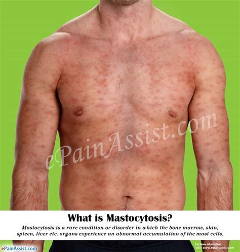 What Is Mastocytosis How Is It Treated