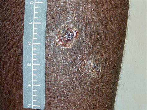 Photograph Of A Crusted Skin Sore Classical Features Include A 1 Cm
