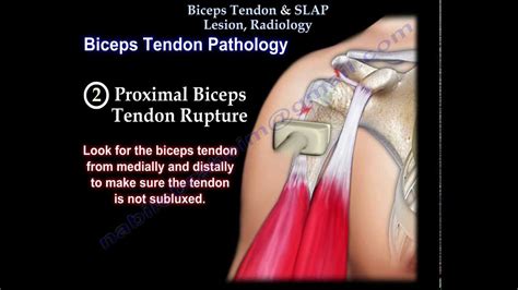 Biceps Tendon SLAP Lesion Radiology Everything You Need To Know