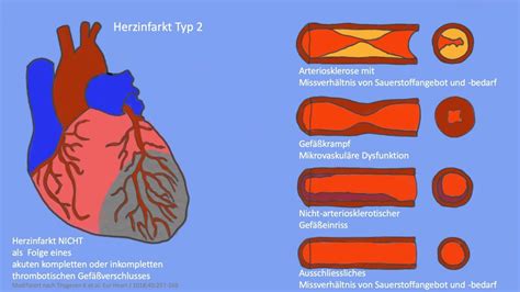 Ein Herzinfarkt Kann Verschiedene Ursachen Haben Cardiopraxis®