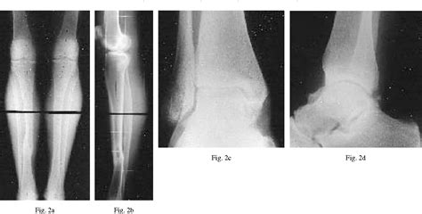 Figure 2 From Degenerative Changes At The Knee And Ankle Related To