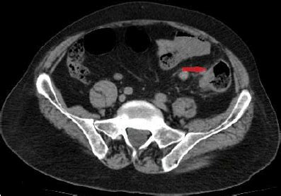 Abdominal CT Scans In Series Indicating The Sigmoid Colon Cancer