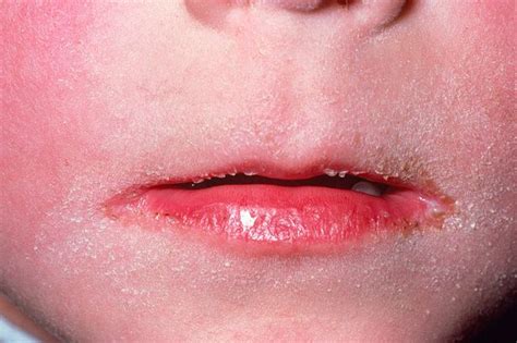 Full List Of Confirmed Scarlet Fever And Strep A Cases Where You Live