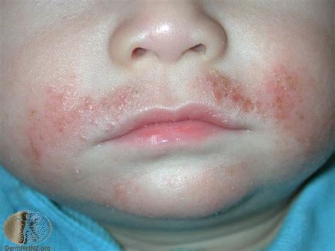 Baby Allergy Rash On Face