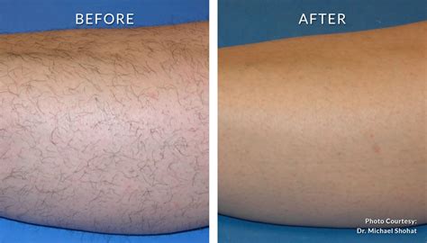 Brazilian Laser Hair Removal Before And After Pics Ideas Eco Mark