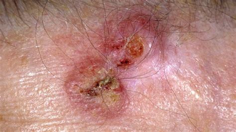 Discolored Skin Patches Pictures Causes And Treatments
