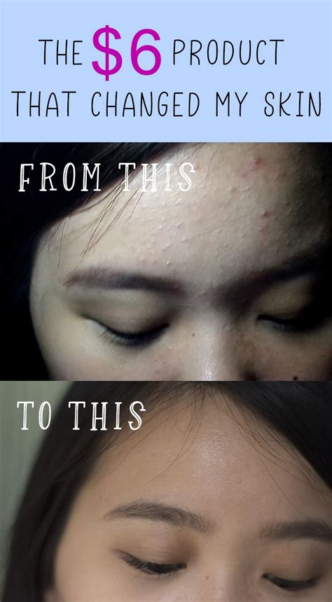 How I Cleared My Tiny Bumps On Forehead Once For All Artofit