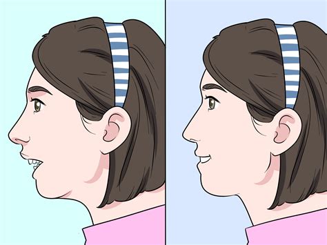 Estrabillo gives an overview on different types of malocclusions, along with what causes them, and ways they are corrected. オーバーバイトの治療方法: 9 ステップ (画像あり) - wikiHow