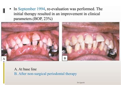 Case Report Chronic Generalized Periodontitis With Type 2 Dm