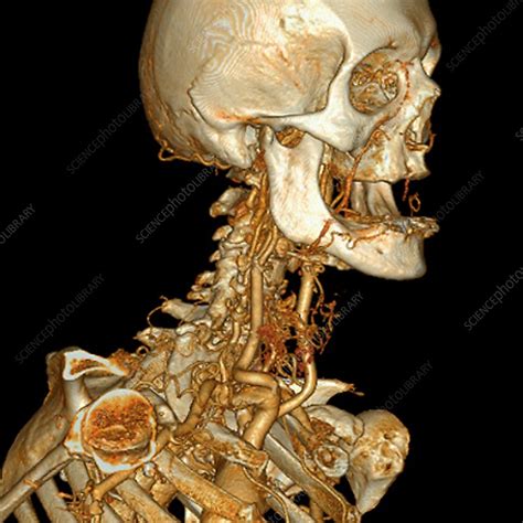 Neck And Head Arteries 3d Angio Ct Scan Stock Image C0096793