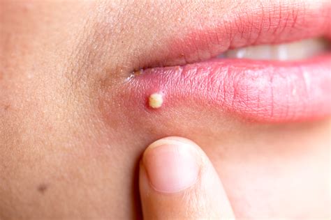 Causes Of The White Bumps On Lips Stdgov Blog