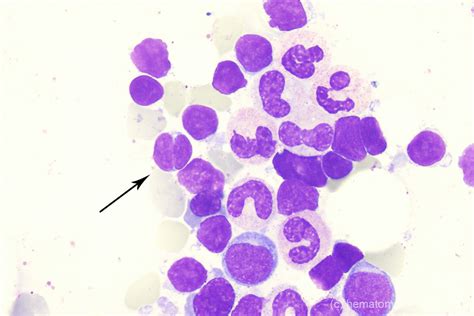 Follicular Lymphoma Fl Hematomorphology A Databank Imagebank For