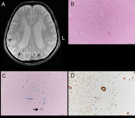 Cerebral Microbleeds Detected Using 30t Magnetic Resonance Imaging In