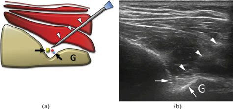 A Scheme And B Ultrasound Image Of Suprascapular Nerve Block At The