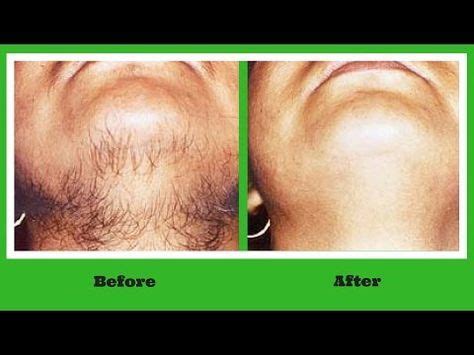 How To Get Rid Of Facial Hair Naturally Permanently At Home Remove