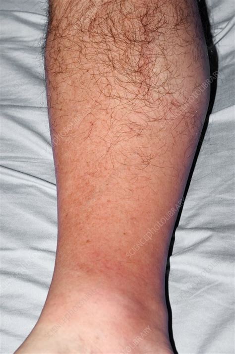 Cellulitis Of The Leg Stock Image C0044223 Science Photo Library