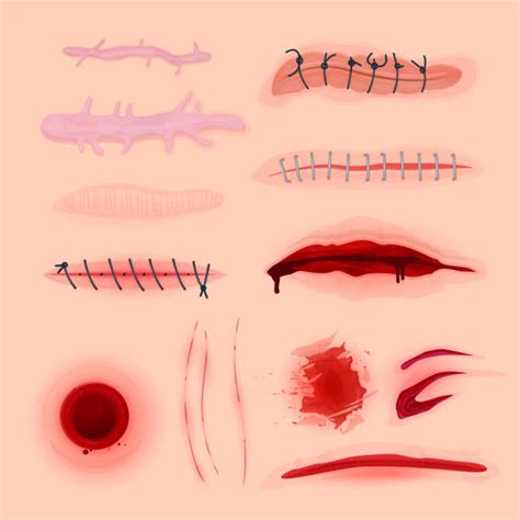 Medical Stitches Illustrations Royalty Free Vector Graphics And Clip Art