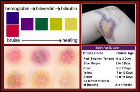 Bruises The Secret Behind The Rainbow Of Colors Complete Wellness Report