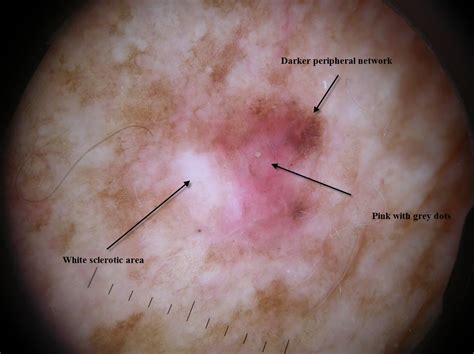 Dermpath Made Simple Neoplastic Desmoplastic Melanoma