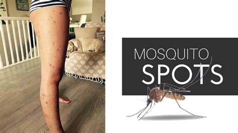 Yeah one spot is fine, but to many in enough, how to i get rid of it? Skincare l Ways to Treat Dark Spots on LEGS l Mosquito ...