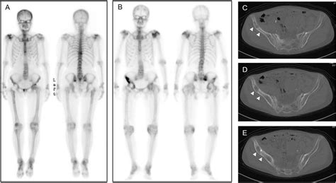 A Bone Scintigraphy Obtained 14 Years After The Primary Tha Showed