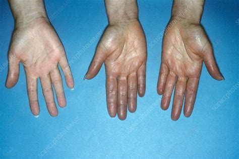 Acrocyanosis Of The Hands Stock Image C0235726 Science Photo Library