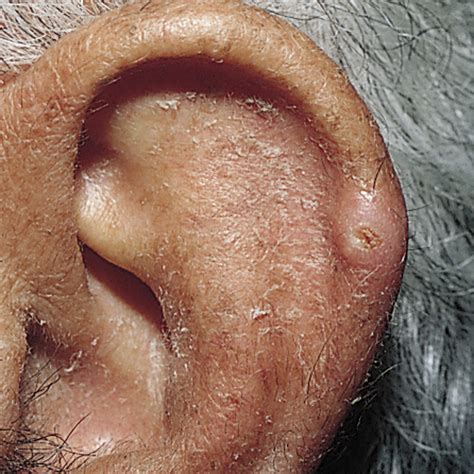 Chondrodermatitis Cnh Ear Pressure Sore Information And Advice