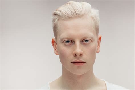 Albinos kim jest cechy choroby wykluczenie społeczne Zdrowie Wprost