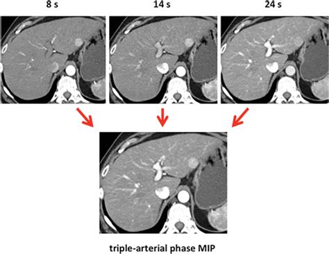 Triple Arterial Phase Ct Of The Liver With Radiation Dose Equivalent To