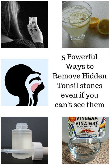 Pin On Tonsil Stones Remedies