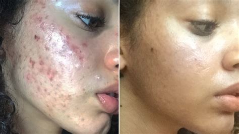 This All Natural Acne Skin Care Routine Is Going Viral On Instagram