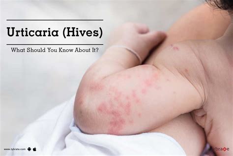 Urticaria Hives What Should You Know About It By Dr Rupa Shah Lybrate