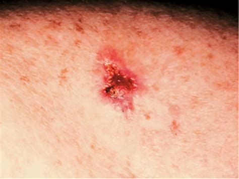 Basal Cell Carcinoma Warning Signs And Images The Skin Cancer Foundation