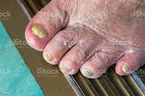 Fungus Infection On Nails Of Mans Foot And Skin Peeling Stock Photo