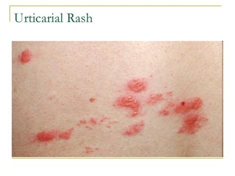 Anaphylaxis Rash Anaphylaxis An Overview Health And Medical