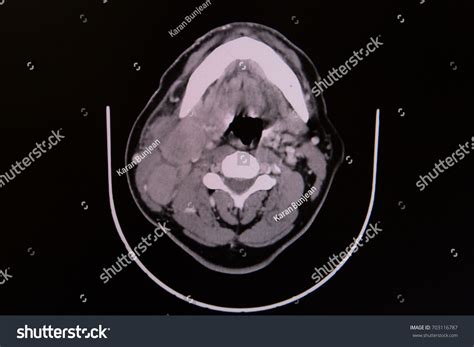 Ct Scan Neck Showing Enlarged Multiple Stock Photo 703116787 Shutterstock