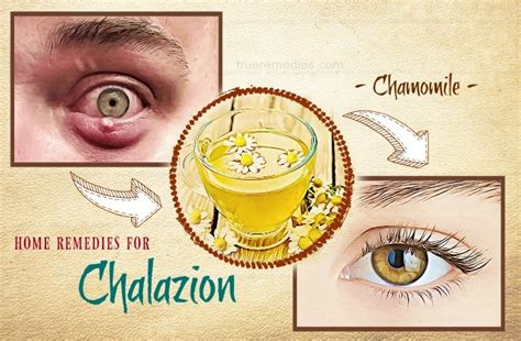 38 Natural Home Remedies For Chalazion Cysts On The Eyelid