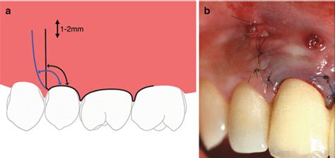 Endodontic Microsurgery For Molars Pocket Dentistry