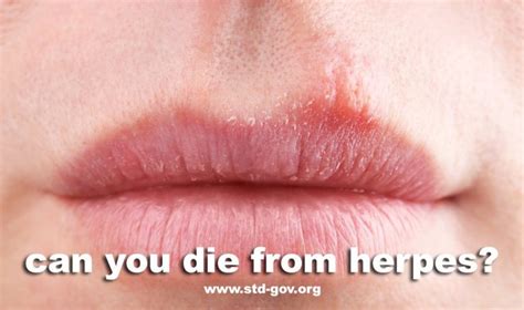 Can You Die From Herpes Stdgov Blog