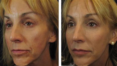 The short and spiky haircut is very popular amongst trends in female grooming. Fillers: Juvederm - Liquid Lift Lips pluming Cheek filler ...