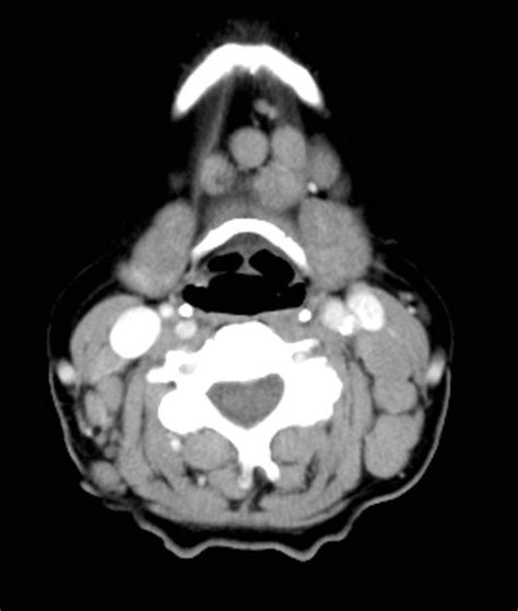 Lymphoma Neck Nodes Radiology Case