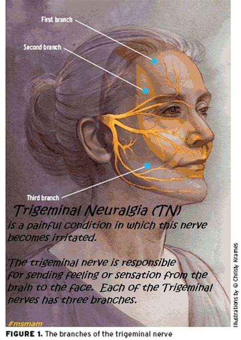 Trigeminal Neuralgia Massage