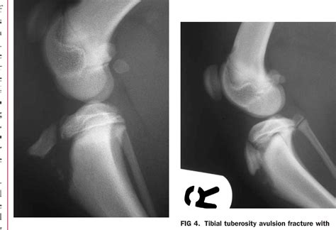 Tibial Tuberosity Avulsion Fracture In Dogs A Review Of 59 Dogs